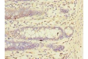 Immunohistochemistry of paraffin-embedded human colon cancer using ABIN7151244 at dilution of 1:100