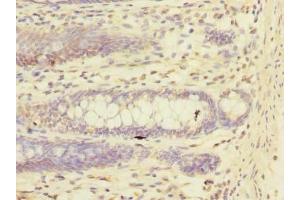 Immunohistochemistry of paraffin-embedded human colon cancer using ABIN7151244 at dilution of 1:100 (TRIM17 / RNF16 anticorps  (AA 1-300))
