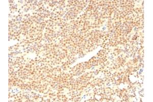 Formalin-fixed, paraffin-embedded human Mantle Cell Lymphoma stained with Cyclin D1 Mouse Monoclonal Antibody (CCND1/2593). (Cyclin D1 anticorps)