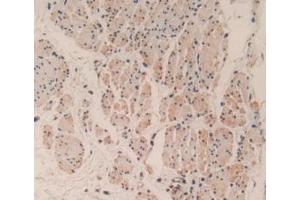 IHC-P analysis of Human Esophagus Cancer Tissue, with DAB staining. (Caspase 3 anticorps  (AA 29-175))