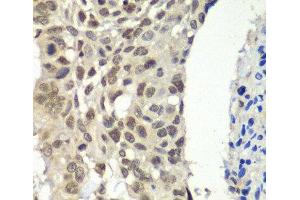 Immunohistochemistry of paraffin-embedded Human esophageal cancer using SSRP1 Polyclonal Antibody at dilution of 1:100 (40x lens). (SSRP1 anticorps)