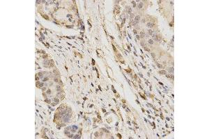 Immunohistochemistry of paraffin-embedded human stomach cancer using GLB1 antibody at dilution of 1:200 (x400 lens) (GLB1 anticorps  (AA 1-270))