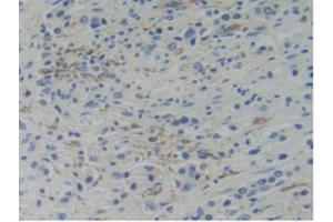 IHC-P analysis of Human Prostate Gland Cancer Tissue, with DAB staining. (WARS anticorps  (AA 247-458))