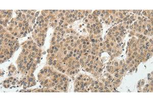 Immunohistochemistry of paraffin-embedded Human liver cancer tissue using SOCS7 Polyclonal Antibody at dilution 1:30 (SOCS7 anticorps)