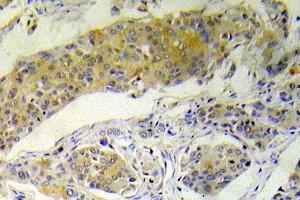 Immunohistochemistry (IHC) analyzes of p-BAD antibody in paraffin embedded human breast carcinoma tissue. (BAD anticorps  (pSer112))