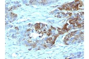 Formalin-fixed, paraffin-embedded human colon carcinoma stained with Blood Group Antigen H Type 2 antibody (19-OLE)