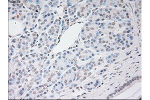 Immunohistochemical staining of paraffin-embedded Adenocarcinoma of breast tissue using anti-VEGF mouse monoclonal antibody. (VEGF anticorps  (AA 27-233))