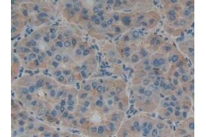 Detection of TNFSF14 in Human Liver cancer Tissue using Polyclonal Antibody to Tumor Necrosis Factor Ligand Superfamily, Member 14 (TNFSF14)