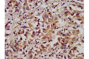 IHC image of ABIN7143473 diluted at 1:300 and staining in paraffin-embedded human liver cancer performed on a Leica BondTM system. (ARL1 anticorps  (AA 2-181))
