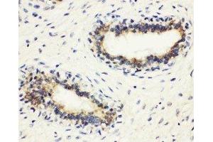 Anti-HLA DMB antibody, IHC(P) IHC(P): Human Mammary Cancer Tissue
