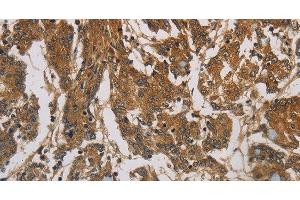 Immunohistochemistry of paraffin-embedded Human colon cancer using CORO1C Polyclonal Antibody at dilution of 1:60