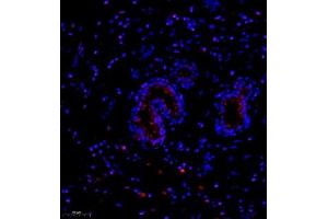 Immunofluorescence of paraffin embedded human breast cancer using NCK (ABIN7074783) at dilution of 1:1000 (250x lens) (NCK2 anticorps)