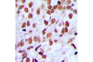 Immunohistochemical analysis of FOXK1 staining in human breast cancer formalin fixed paraffin embedded tissue section.