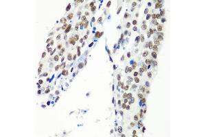 Immunohistochemistry of paraffin-embedded human lung cancer using HTATSF1 antibody (ABIN5973562) at dilution of 1/100 (40x lens). (HTATSF1 anticorps)