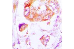 Immunohistochemical analysis of CK1 alpha staining in human lung cancer formalin fixed paraffin embedded tissue section.