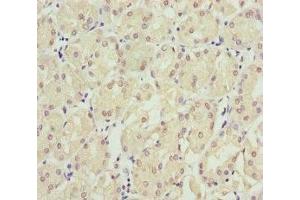 Immunohistochemistry of paraffin-embedded human gastric cancer using ABIN7151953 at dilution of 1:100 (Eppin anticorps  (AA 22-133))
