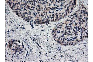 Immunohistochemical staining of paraffin-embedded Carcinoma of Human pancreas tissue using anti-TMOD1 mouse monoclonal antibody. (Tropomodulin 1 anticorps)