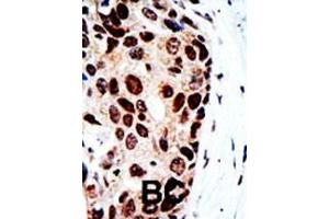Formalin-fixed and paraffin-embedded human cancer tissue reacted with the primary antibody, which was peroxidase-conjugated to the secondary antibody, followed by DAB staining.