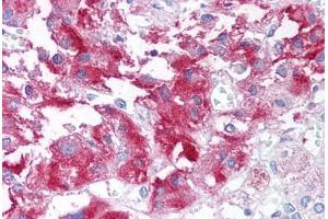 Human Adrenal Medulla (formalin-fixed, paraffin-embedded) stained with USP20 antibody ABIN213604 at 10 ug/ml followed by biotinylated goat anti-rabbit IgG secondary antibody ABIN481713, alkaline phosphatase-streptavidin and chromogen.