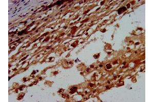 IHC image of ABIN7145615 diluted at 1:400 and staining in paraffin-embedded human melanoma performed on a Leica BondTM system. (BTD anticorps  (AA 322-397))