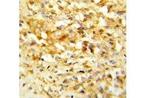 IHC analysis of FFPE human prostate carcinoma stained with NKX3. (NKX3-1 anticorps  (AA 118-145))