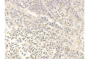 ABIN6266072 and ABIN6266816 at 1/100 staining human non-Hodgkin lymphoma by IHC-P. (XRN2 anticorps)