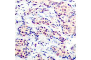 Immunohistochemical analysis of paraffin-embedded human breast carcinoma tissue using JunD (Ab-255) antibody (#B7137). (JunD anticorps  (Ser255))