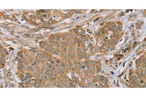 Immunohistochemistry of paraffin-embedded Human cervical cancer tissue using RNF148 Polyclonal Antibody at dilution 1:45 (RNF148 anticorps)