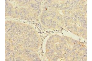 Immunohistochemistry of paraffin-embedded human endometrial cancer using ABIN7148571 at dilution of 1:100 (CIR1 anticorps  (AA 1-160))