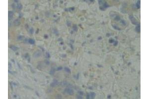 IHC-P analysis of Human Breast Cancer Tissue, with DAB staining. (BMX anticorps  (AA 287-523))