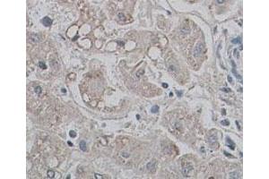 Immunohistochemical staining of formalin-fixed paraffin-embedded human liver tissue showing membrane staining with AQP9 polyclonal antibody  at 1 : 100 dilution. (AQP9 anticorps  (N-Term))