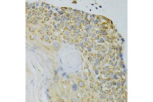 Immunohistochemistry of paraffin-embedded human esophageal cancer using GPX4 Antibody (ABIN5970997) at dilution of 1/200 (40x lens). (GPX4 anticorps)