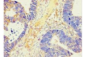 Immunohistochemistry of paraffin-embedded human ovarian cancer using ABIN7143846 at dilution of 1:100 (AMY2B anticorps  (AA 16-320))