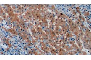 Detection of ARG in Human Liver cancer Tissue using Monoclonal Antibody to Arginase (ARG) (ARG anticorps  (AA 1-322))