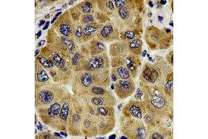 Immunohistochemical analysis of Centrin-1 staining in human liver cancer formalin fixed paraffin embedded tissue section. (Centrin 1 anticorps)