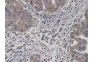 IHC-P analysis of Human Liver cancer Tissue, with DAB staining. (CROT anticorps  (AA 410-612))