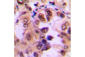 Immunohistochemical analysis of IKB alpha (pS32/S36) staining in human breast cancer formalin fixed paraffin embedded tissue section.