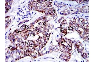 Immunohistochemical analysis of paraffin-embedded human bladder cancer tissues using KRT19 mouse mAb with DAB staining. (Cytokeratin 19 anticorps)