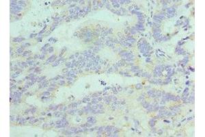 Immunohistochemistry of paraffin-embedded human colon cancer using ABIN7152772 at dilution of 1:100