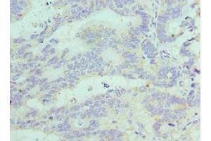 Immunohistochemistry of paraffin-embedded human colon cancer using ABIN7152772 at dilution of 1:100 (FGF1 anticorps  (AA 16-155))
