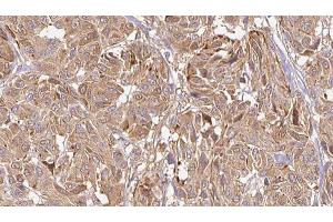ABIN6269002 at 1/100 staining Human Melanoma tissue by IHC-P. (COL2A1 anticorps  (N-Term))