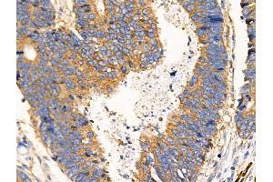 ABIN6259147 and ABIN6274943 at 1/100 staining Human colorectal cancer by IHC-P. (PDE4C anticorps  (Internal Region))