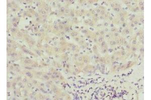 Immunohistochemistry of paraffin-embedded human liver cancer using ABIN7146346 at dilution of 1:100 (CALCOCO1 anticorps  (AA 462-691))