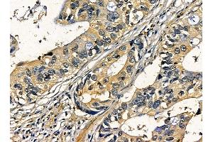 ABIN7095313 and ABIN7099370 at 1/100 staining human pancreatic cancer by IHC-P. (C2CD2 anticorps)