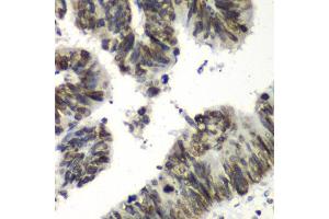 Immunohistochemistry of paraffin-embedded human colon carcinoma using TEAD1 antibody at dilution of 1:100 (x40 lens). (TEAD1 anticorps)