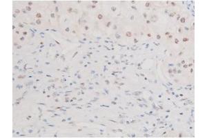 ABIN6267579 at 1/200 staining Human kidney cancer tissue sections by IHC-P. (FOXO4 anticorps  (pSer197))