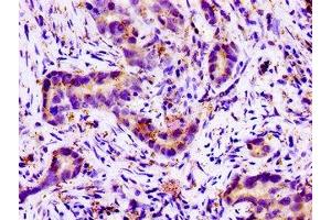Immunohistochemistry of paraffin-embedded human pancreatic cancer using ABIN7161093 at dilution of 1:100