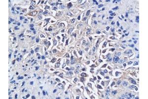 Formalin-fixed and paraffin embedded mouse hepatic tumor labeled with Anti-CD150/SLAMF1 Polyclonal Antibody, Unconjugated followed by conjugation to the secondary antibody and DAB staining (SLAMF1 anticorps  (AA 231-335))