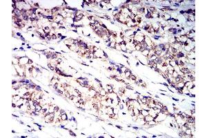 Immunohistochemical analysis of paraffin-embedded bladder cancer tissues using CD114 mouse mAb with DAB staining.