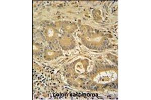 IT Antibody (C-term) (ABIN389476 and ABIN2839538) iunohistochemistry analysis in formalin fixed and paraffin embedded human colon carcinoma followed by peroxidase conjugation of the secondary antibody and DAB staining.